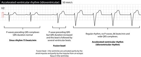 Ventricular rhythm and accelerated ventricular rhythm (idioventricular ...