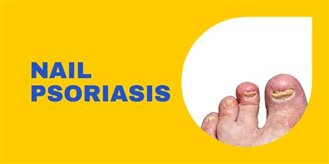 Nail Psoriasis - Ayurvedic Psoriasis Treatment