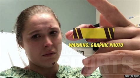 Ronda Rousey Suffers GRUESOME Injury Filming TV Show (PHOTO)