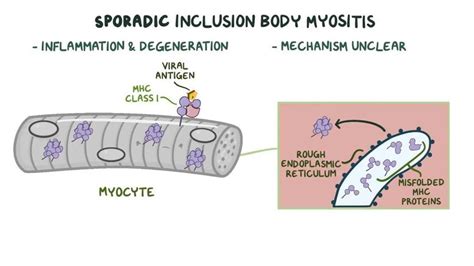 Inclusion body myopathy: Video, Anatomy & Definition | Osmosis