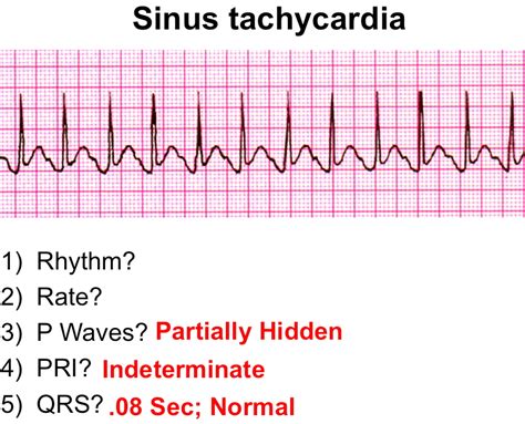 Sinus Tachycardia