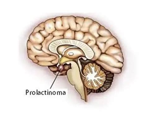 Pituitary prolactinoma: causes, symptoms, diagnosis and treatment. What ...