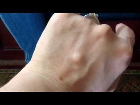 What is this Hard Lump on my hand? Ganglion Cyst #1 - YouTube