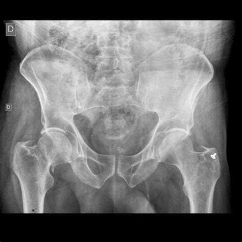 Subcapital Left Femoral Neck Fracture