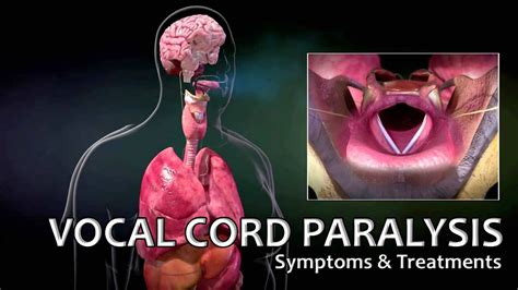 Vocal Cord Paralysis - Causes, Symptoms, Recovery, Surgery, Treatment