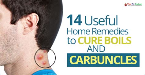 14 Powerful Natural Remedies for Painful Boils and Carbuncles