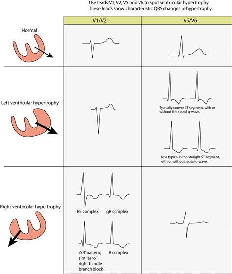 The ECG in left ventricular hypertrophy (LVH): criteria and ...