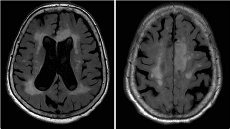 Neuroimaging - Why would white matter hyperintensities (WMH) seem to ...