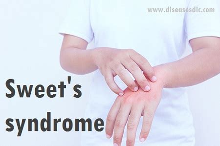 Sweet Syndrome - Symptoms, complications, and Treatment.