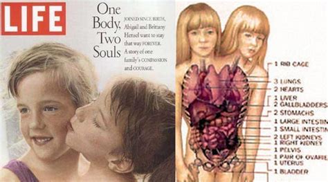 Everything To Know About Famous Conjoined Twins Abby And Brittany ...