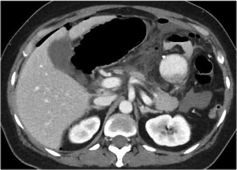 Case 1. Axial view of the CECT of the abdomen. The stomach is dilated ...