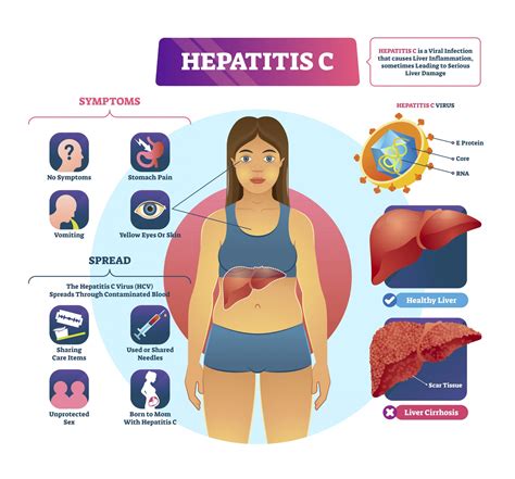 Hepatitis C | GUTCARE