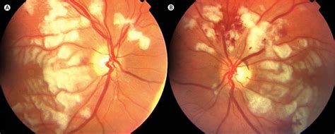 Purtscher-like retinopathy caused by acute pancreatitis - The Lancet