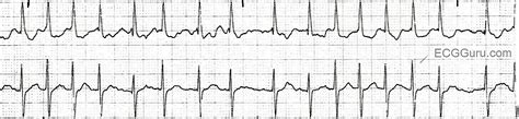 ECG Basics: Atrial Fibrillation With a Rapid Ventricular Response | ECG ...