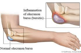 Elbow Bursitis Treatment - Denver's Best | 5280 Cryo & Recovery Clinic