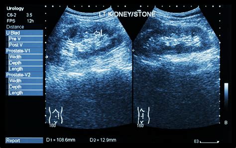 Bilateral Renal Parenchymal Disease - What EXACTLY Does It Mean?