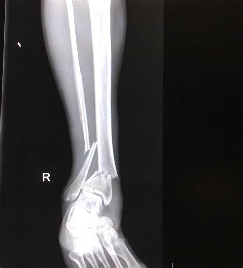 Leg Fracture X Ray