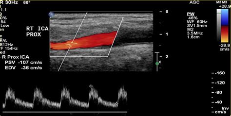 Carotid Artery (Cerebrovascular) | Vascular Center | UC Davis Health