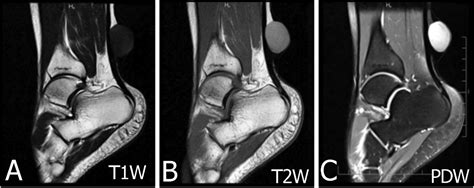 Overview of epidermoid cyst - European Journal of Radiology Open