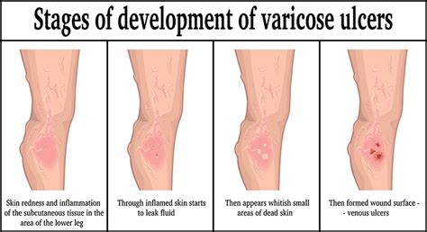 What are Venous Leg Ulcers: Advanced Vein Therapy