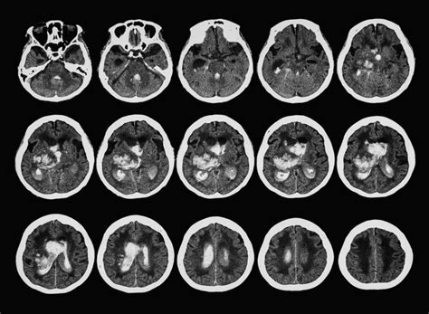 The role of CT and MR in stroke patients