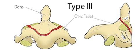 Odontoid Fracture Types