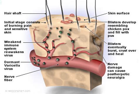 Shingles (Herpes Zoster) - Apex Dermatology & Skin Surgery Center ...