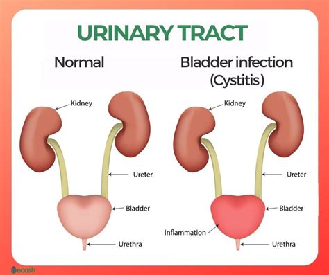 Bladder infection cystitis symptoms causes and natural remedies for ...