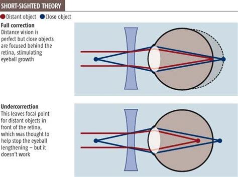 Eye correction is seriously short sighted | New Scientist