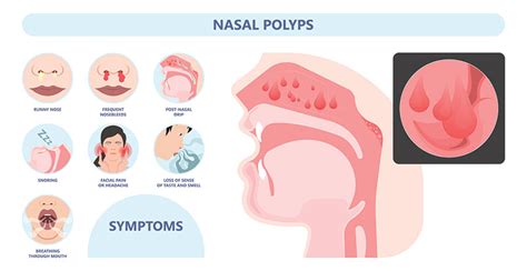 Nasal Polyps Houston | Nasal Polyp Removal The Woodlands