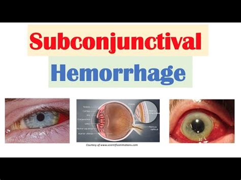 Hemorrhage In The Eye - Causes, Treatment, Hemorrhage After Impact ...