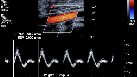 Doppler Ultrasound – Vitalim