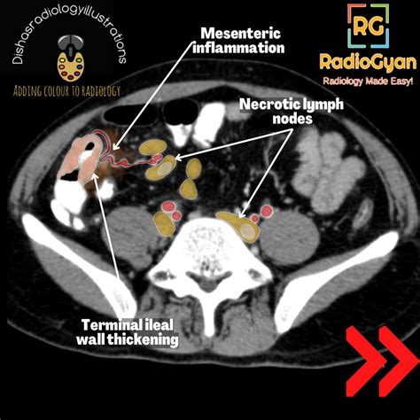 Ileocecal tuberculosis | Radiology Case | - RadioGyan