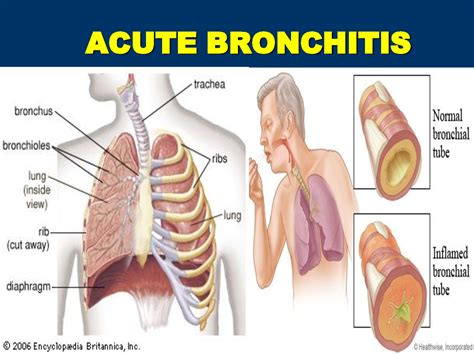 Acute Bronchitis In Adults And Children Causes, Symptoms, Diagnosis ...