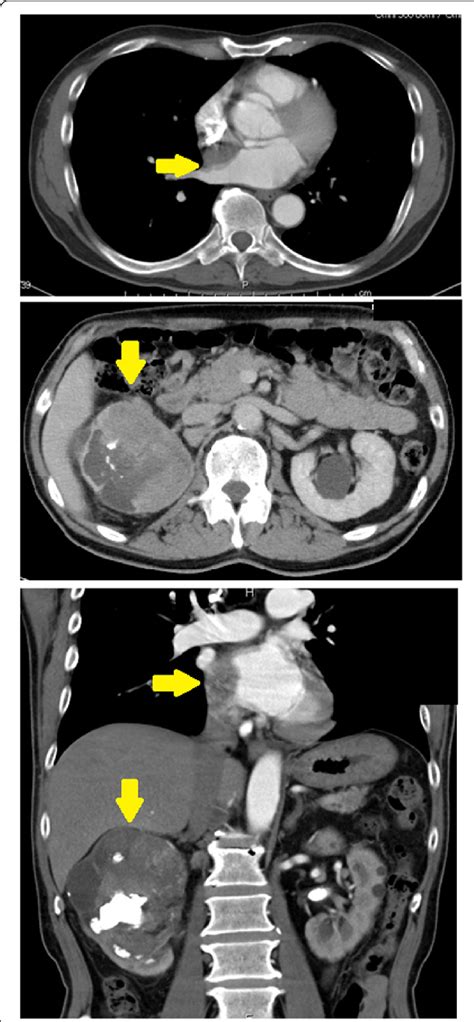 Computed tomography at the first examination. Top: computed tomography ...