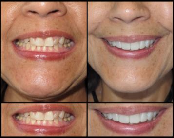 Porcelain Veneers for a Beautiful Smile | Dr. Jamie Sands