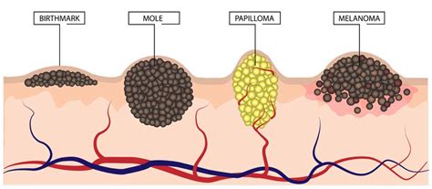 Skin Moles Types