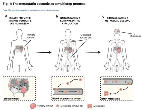 'The lingering mysteries of metastatic recurrence in breast cancer' in ...