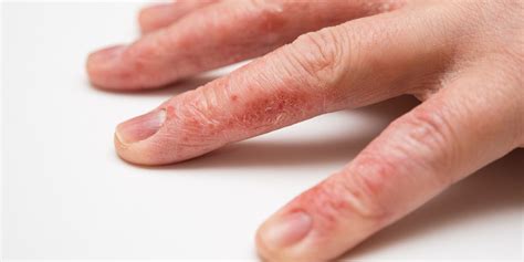 Hand Eczema: 8 Ways to Deal With This Frustrating Condition | SELF