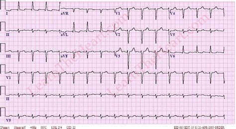 Accelerated Junctional Rhythm ECG Example 2 | LearntheHeart.com