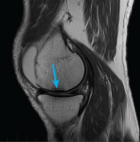 mri-knee-meniscus-tear - MRI at Melbourne Radiology Clinic