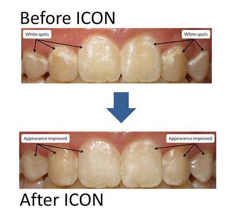 ICON White Spot and Discolored Tooth Treatment | Chestnut Dental ...