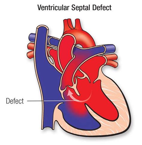 Ventricular Septal Defect (VSD) | American Heart Association ...