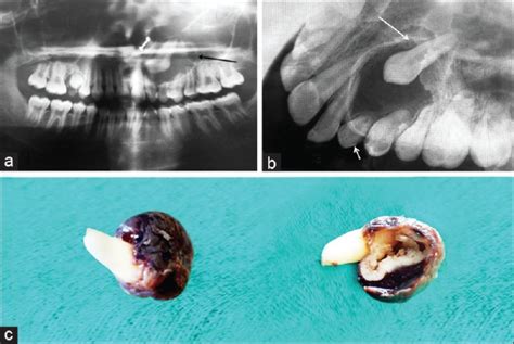 Adenomatoid odontogenic tumor: A unique report with histological ...