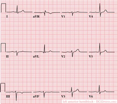 Left anterior fascicular block electrocardiogram - wikidoc