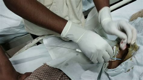 Femoral Venous Catheter