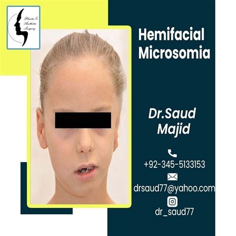 Hemifacial Microsomia | Cleft lip and palate, Cleft lip, Cosmetic surgery