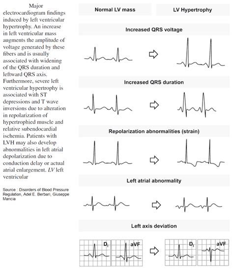 Left Ventricular Hypertrophy (LVH): How to Recognize it on ECG [With ...