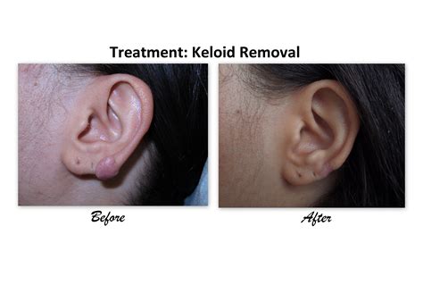 LANAP Dentist in South Side Chicago| Keloid Removal | Dentist South ...