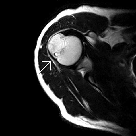 Pitching Injury-MRI Shoulder - Sumer's Radiology Blog